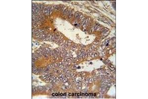 P1S Antibody (Center) (ABIN651956 and ABIN2840474) immunohistochemistry analysis in forlin fixed and paraffin embedded hun colon carcino followed by peroxidase conjugation of the secondary antibody and DAB staining. (MAP1S 抗体  (AA 493-520))