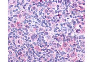 Anti-CHRM4 / M4 antibody IHC of human Lymph Node, Hodgkins Lymphoma. (CHRM4 抗体  (Cytoplasmic Domain))