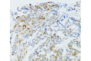 Immunohistochemistry of paraffin-embedded Human liver cancer using EGFR Polyclonal Antibody at dilution of 1:100 (40x lens).