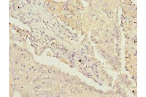 Immunohistochemistry of paraffin-embedded human lung cancer using ABIN7142207 at dilution of 1:100 (PSMD13 抗体  (Regulatory Subunit 13))
