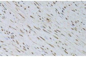 Immunohistochemistry of paraffin-embedded Human uterine cancer using HDGFRP3 Polyclonal Antibody at dilution of 1:100 (40x lens). (HDGFRP3 抗体)