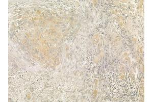 ABIN6257109 and ABIN6274623 at 1/100 staining human tongue carcinoma by IHC-P.