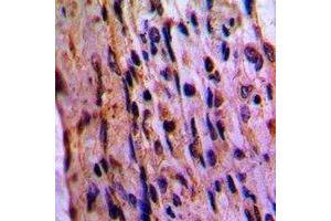 Immunohistochemical analysis of EIF3D staining in human lung cancer formalin fixed paraffin embedded tissue section. (EIF3D 抗体)