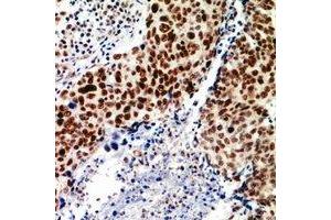 Immunohistochemical analysis of TEAD2 staining in human breast cancer formalin fixed paraffin embedded tissue section. (TEAD2 抗体)