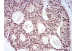 Immunohistochemistry (IHC) image for anti-O6-Methylguanine-DNA-Methyltransferase (MGMT) (AA 32-210) antibody (ABIN5542437)