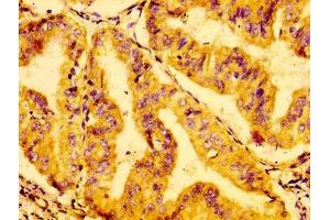 IHC image of ABIN7154498 diluted at 1:100 and staining in paraffin-embedded human cervical cancer performed on a Leica BondTM system. (GRB14 抗体  (AA 294-397))
