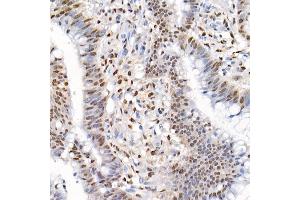 Immunohistochemistry of paraffin-embedded human colon carcinoma using Phospho-Smad2-S465/467 + Smad3-S423/425 Rabbit pAb (ABIN6135314, ABIN6136248, ABIN6136249 and ABIN6225575) at dilution of 1:50 (40x lens). (SMAD2 / SMAD3 (pSer423), (pSer425) 抗体)