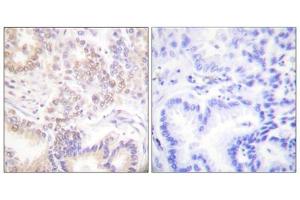 Immunohistochemistry analysis of paraffin-embedded human lung carcinoma tissue using SENP5 antibody. (SENP5 抗体  (C-Term))