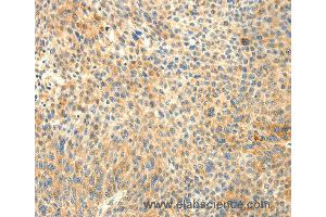 Immunohistochemistry of Human liver cancer using TRAF3IP2 Polyclonal Antibody at dilution of 1:30 (TRAF3IP2 抗体)