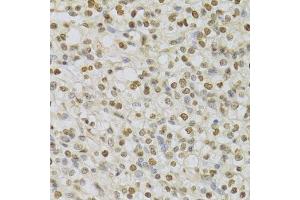 Immunohistochemistry of paraffin-embedded human kidney cancer using HDGF Antibody. (HDGF 抗体  (AA 1-240))