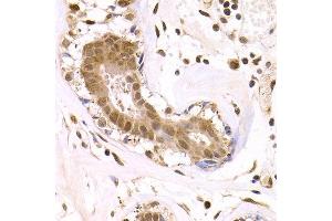 Immunohistochemistry of paraffin-embedded human breast cancer using ODC1 antibody at dilution of 1:200 (400x lens). (ODC1 抗体)
