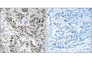 Immunohistochemistry analysis of paraffin-embedded human breast carcinoma tissue, using APBB2 Antibody. (APBB2 抗体  (AA 471-520))
