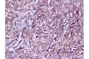 Formalin-fixed and paraffin embedded rat lymphoma tissue labeled with Anti-Ly-6G/Gr-1 Polyclonal Antibody, Unconjugated (ABIN742305) at 1:200 followed by conjugation to the secondary antibody and DAB staining