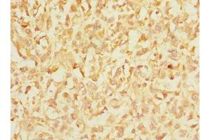 Immunohistochemistry of paraffin-embedded human melanoma using ABIN7156455 at dilution of 1:100 (CD103 抗体  (AA 19-200))