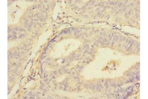 Immunohistochemistry of paraffin-embedded human endometrial cancer using ABIN7159959 at dilution of 1:100 (PMPCA 抗体  (AA 456-525))