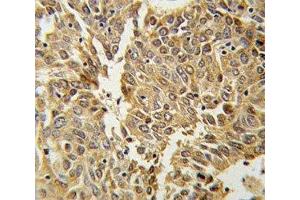 HIF1 alpha antibody IHC analysis in formalin fixed and paraffin embedded lung carcinoma. (HIF1A 抗体  (AA 1-30))