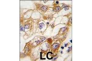Formalin-fixed and paraffin-embedded human lung carcinoma tissue reacted with RGS19 Antibody (S24) (ABIN6243053 and ABIN6577359) , which was peroxidase-conjugated to the secondary antibody, followed by DAB staining. (RGS19 抗体  (AA 9-39))