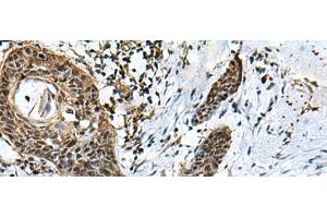 Immunohistochemistry of paraffin-embedded Human esophagus cancer tissue using GLI1 Polyclonal Antibody at dilution of 1:40(x200) (GLI1 抗体)