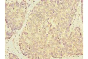 Immunohistochemistry of paraffin-embedded human gastric cancer using ABIN7163860 at dilution of 1:100 (GALNT12 抗体  (AA 1-272))