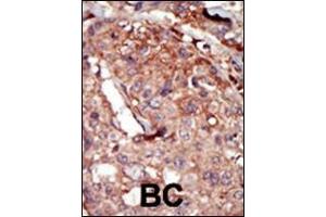 Formalin-fixed and paraffin-embedded human cancer tissue reacted with the primary antibody, which was peroxidase-conjugated to the secondary antibody, followed by AEC staining. (BRD2 抗体  (AA 170-200))