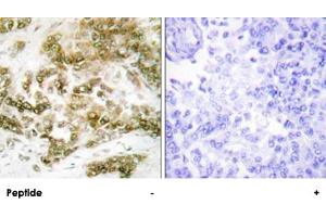 Immunohistochemistry analysis of paraffin-embedded human breast carcinoma tissue using TBX15/TBX18 polyclonal antibody . (T-Box 15 抗体)