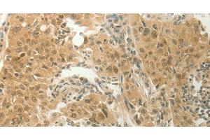 Immunohistochemistry of paraffin-embedded Human lung cancer tissue using SLC8A3 Polyclonal Antibody at dilution 1:70 (SLC8A3 抗体)