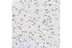 Immunohistochemistry of paraffin-embedded human lung cancer using HMGN1 antibody.