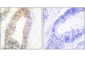 Immunohistochemistry analysis of paraffin-embedded human colon carcinoma tissue, using ZNF638 Antibody. (ZNF638 抗体  (AA 1271-1320))