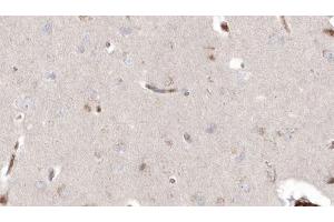 ABIN6272914 at 1/100 staining Human brain cancer tissue by IHC-P. (DHRS3 抗体  (Internal Region))