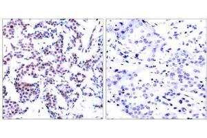 Immunohistochemical analysis of paraffin-embedded human breast carcinoma using JunB (phospho-Ser259) antibody (E011027). (JunB 抗体  (pSer259))