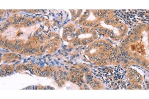 Immunohistochemistry of paraffin-embedded Human thyroid cancer using NCEH1 Polyclonal Antibody at dilution of 1:80 (NCEH1 抗体)