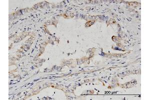 Immunoperoxidase of purified MaxPab antibody to EPS8L2 on formalin-fixed paraffin-embedded human breast cancer. (EPS8-Like 2 抗体  (AA 1-715))