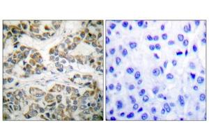 Immunohistochemical analysis of paraffin-embedded human breast carcinoma tissue using Shc (phospho-Tyr349) antibody. (SHC1 抗体  (pTyr349))