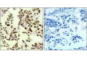 Immunohistochemistry analysis of paraffin-embedded human lung carcinoma, using p73 (Phospho-Tyr99) Antibody. (Tumor Protein p73 抗体  (pTyr99))