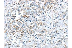 The image on the left is immunohistochemistry of paraffin-embedded Human gastric cancer tissue using ABIN7193036(VWCE Antibody) at dilution 1/30, on the right is treated with synthetic peptide. (VWCE 抗体)