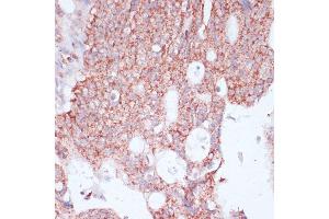 Immunohistochemistry of paraffin-embedded human colon carcinoma using RPL30 antibody (ABIN6130903, ABIN6147135, ABIN6147136 and ABIN6217777) at dilution of 1:100 (40x lens). (RPL30 抗体  (AA 1-115))