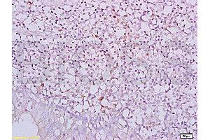 Formalin-fixed and paraffin embedded human nasopharyngeal carcinoma labeled with Anti-NKG2D/CD314/KLRK1 Polyclonal Antibody, Unconjugated (ABIN730078) at 1:200, followed by conjugation to the secondary antibody and DAB staining (KLRK1 抗体  (AA 121-219))