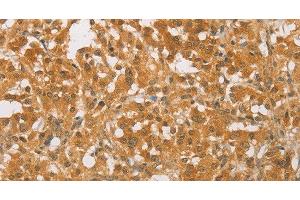 Immunohistochemistry of paraffin-embedded Human thyroid cancer tissue using CEBP beta Polyclonal Antibody at dilution 1:60 (CEBPB 抗体)