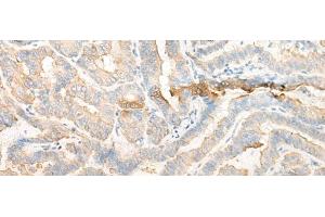 Immunohistochemistry of paraffin-embedded Human thyroid cancer tissue using CELA3A Polyclonal Antibody at dilution of 1:25(x200) (Elastase 3A 抗体)