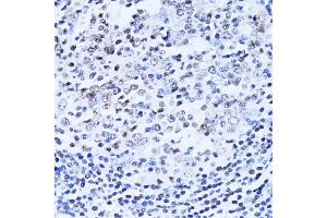 Immunohistochemistry of paraffin-embedded human vermiform appendix using PARP1 Antibody (ABIN5975769) at dilution of 1/100 (40x lens). (PARP1 抗体)