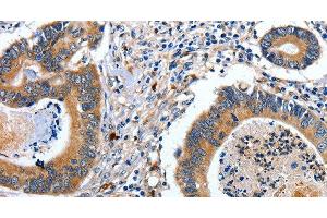Immunohistochemistry of paraffin-embedded Human colon cancer tissue using EFNB2 Polyclonal Antibody at dilution 1:80 (Ephrin B2 抗体)