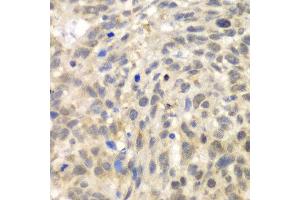 Immunohistochemistry of paraffin-embedded human esophageal cancer using TLK2 antibody at dilution of 1:100 (x40 lens). (TLK2 抗体)