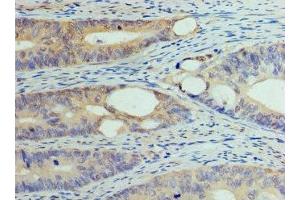 Immunohistochemistry of paraffin-embedded human colon cancer using ABIN7150104 at dilution of 1:100 (DNMT1 抗体  (AA 1288-1632))