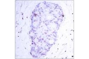 Immunohistochemistry analysis of paraffin-embedded human breast carcinoma, using NF-kappaB p105/p50 (Phospho-Ser907) Antibody. (NFKB1 抗体  (pSer907))
