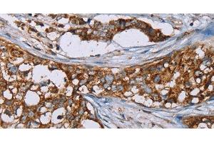 Immunohistochemistry of paraffin-embedded Human breast cancer using BMP6 Polyclonal Antibody at dilution of 1:50 (BMP6 抗体)