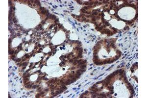 Immunohistochemical staining of paraffin-embedded Adenocarcinoma of Human colon tissue using anti-RUVBL2 mouse monoclonal antibody. (RUVBL2 抗体  (AA 113-370))