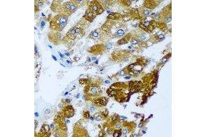 Immunohistochemical analysis of BLVRB staining in human liver cancer formalin fixed paraffin embedded tissue section. (BLVRB 抗体)