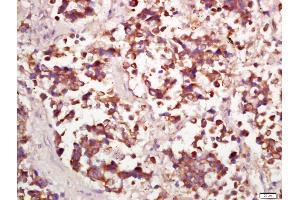 Formalin-fixed and paraffin embedded human lung carcinoma labeled with Anti-PPP4C Polyclonal Antibody, Unconjugated (ABIN669261) at 1:200 followed by conjugation to the secondary antibody and DAB staining (PPP4C 抗体  (AA 265-307))