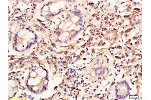 Formalin-fixed and paraffin embedded: human colon carcinoma labeled with Anti-Cyclin C Polyclonal Antibody, Unconjugated  at 1:300, followed by conjugation to the secondary antibody and DAB staining (Cyclin C 抗体  (AA 23-100))