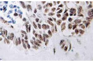 Immunohistochemistry (IHC) analyzes of ZIP-kinase antibody in paraffin-embedded human lung carcinoma tissue. (DAPK3 抗体)